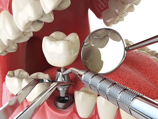 Best Emergency Wisdom Teeth Removal in Wrangell, AK